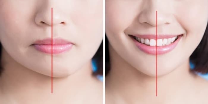 Do I need orthodontics or teeth braces? 3 points to check
