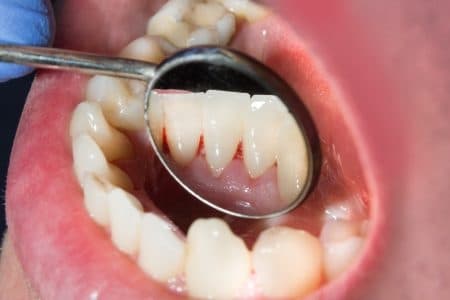 Do I need orthodontics or teeth braces? 3 points to check