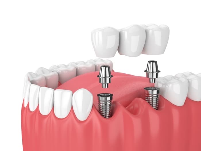 Differences between traditional vs non-invasive dental implant techniques?