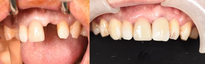 Differences between traditional vs non-invasive dental implant techniques?