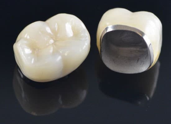 金屬合金烤瓷金屬牙冠