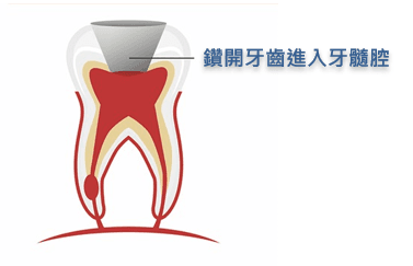 杜牙根手術