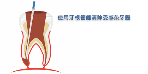 杜牙根清除感染