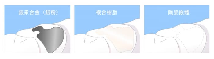 補牙價錢