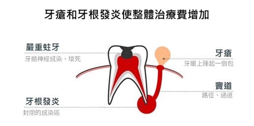 杜牙根治療費用
