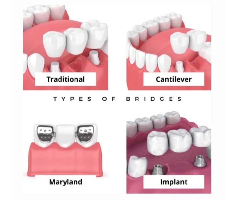 Missing a Tooth? How Dental Bridges Work and Whether They Suit You