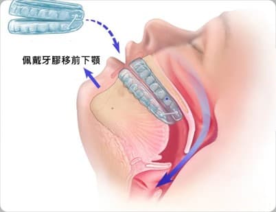 睡眠窒息症牙膠