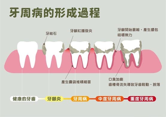牙周病