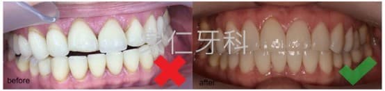 Comparison of veneer repair before and after. The left side shows the condition before repair, with poorly installed veneers causing misalignment and aesthetic issues; the right side shows the condition after repair, with well-installed veneers resulting in properly aligned and naturally aesthetic teeth.