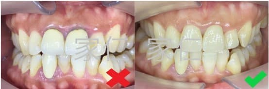 Comparison of crown repair before and after. The left side shows the condition before repair, with poorly installed crowns causing misalignment and gum issues; the right side shows the condition after repair, with well-installed crowns resulting in properly aligned teeth and healthy, natural gums.