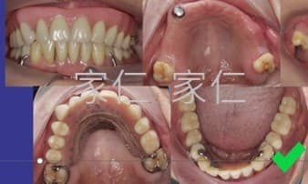 ull mouth rehabilitation denture case comparison. The top left shows the condition of the teeth before treatment, while the top right and bottom images show the post-treatment condition with dentures successfully restoring the function and aesthetics of the mouth.