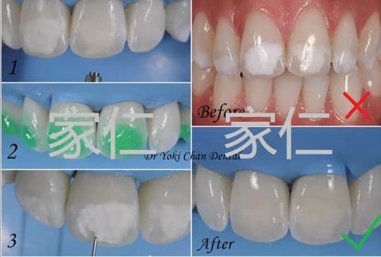 牙齿白斑ICON治疗前后对比：显示治疗前的牙齿白斑、酸性溶液处理牙齿表面、渗透剂应用以及治疗后的最终效果，显著改善牙齿外观