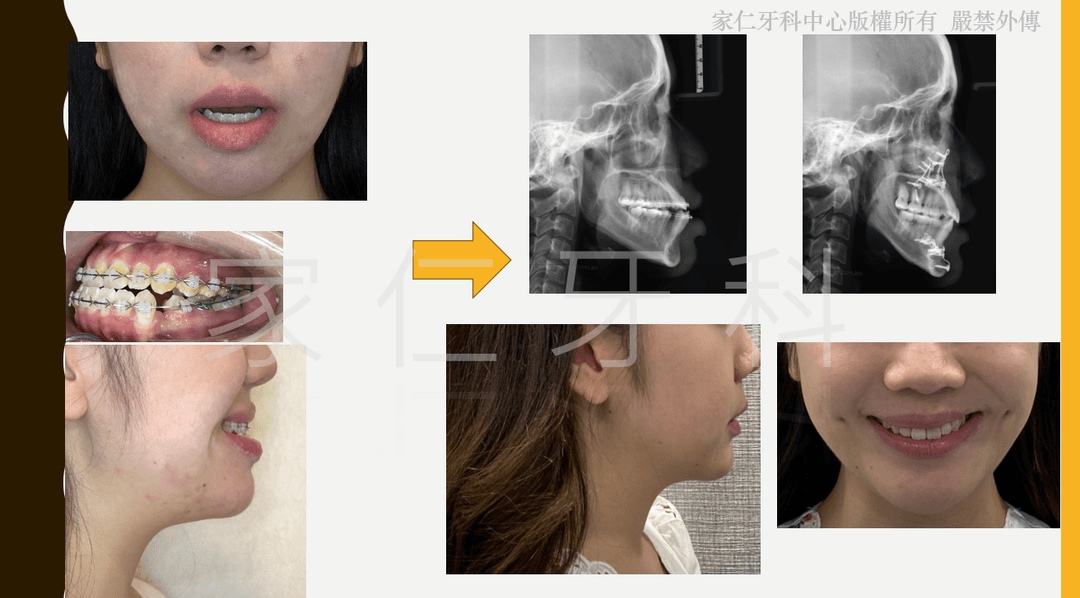 Significant profile change and aesthetic improvement before and after combined orthodontic treatment and orthognathic surgery: showing the correction of jaw misalignment and enhancement of facial symmetry, resulting in a more balanced and harmonious appearance.