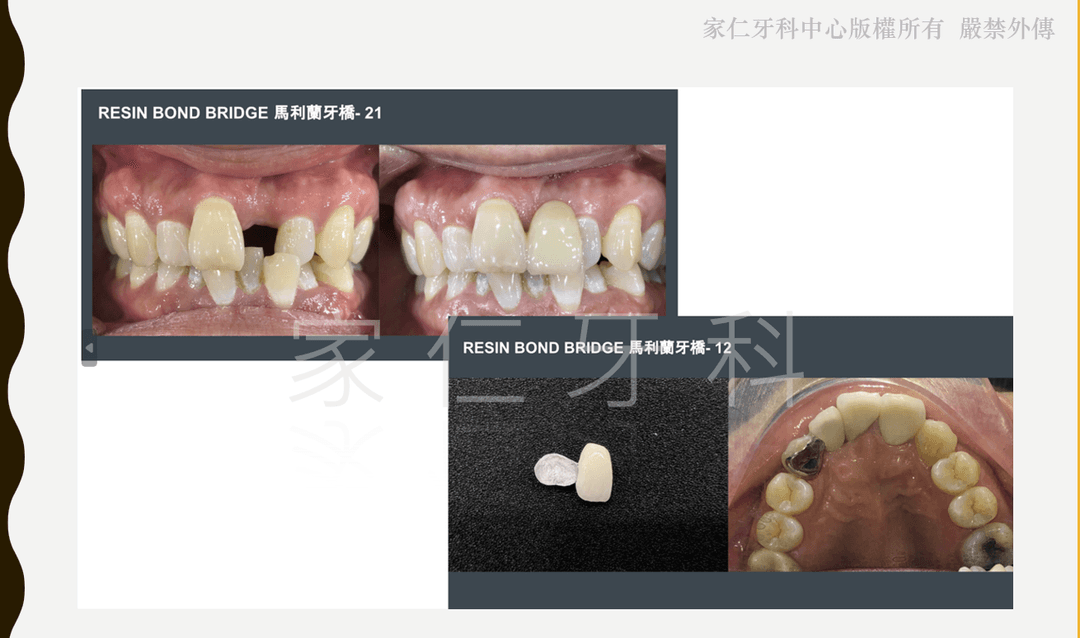 樹脂黏著牙橋治療前後對比圖，展示了以微創方式改善美觀的效果。