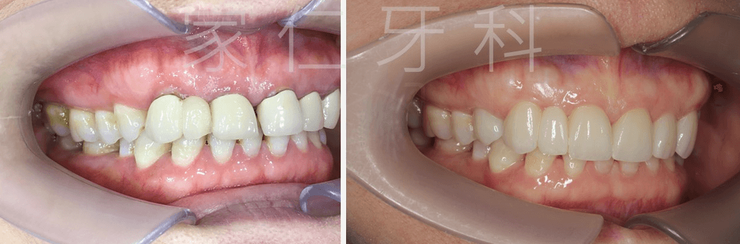 Before and after images of a failed and unesthetic 6-unit dental bridge remake and changeover case, showing significant improvement in dental aesthetics and function.