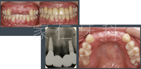 Images show before and after a carefully planned and executed implant for anterior teeth, enhancing the aesthetics and function for the patient.