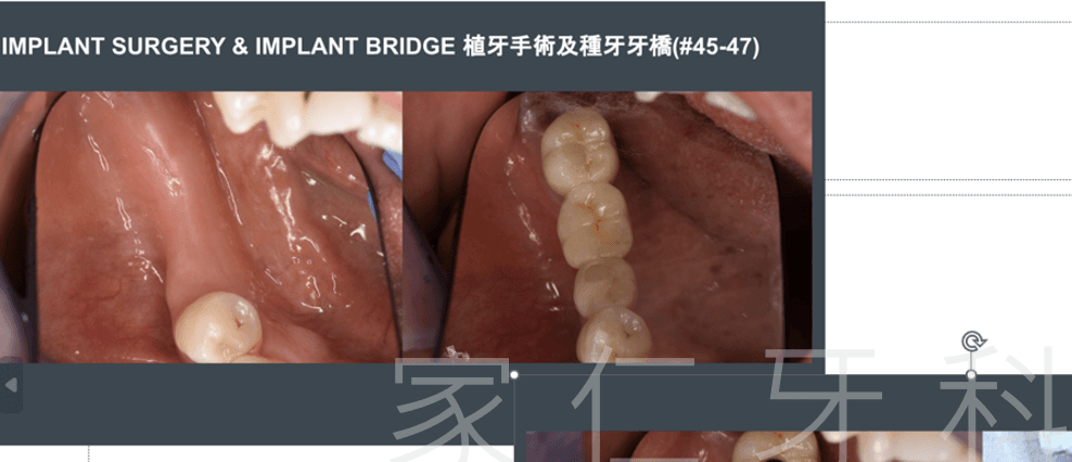 Posterior implant teeth replacement pre and post-op comparison, showing the condition before and after surgery.