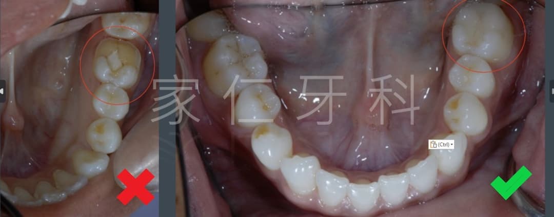 fractured existing filling replaced with onlay before and after treatment 