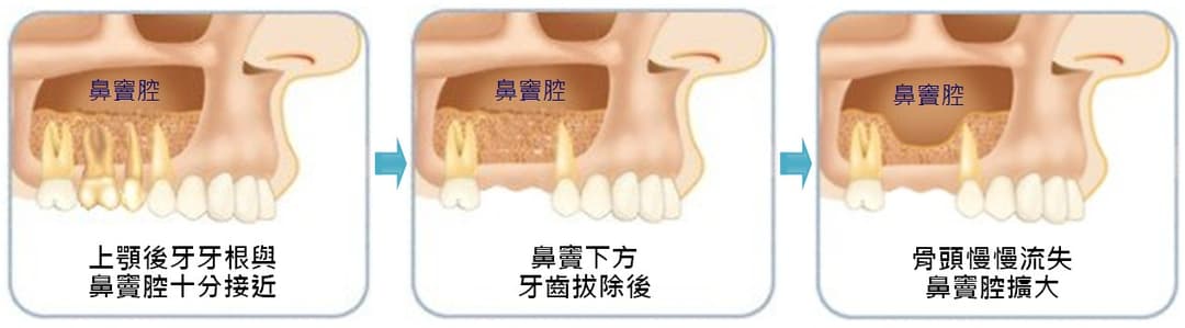 鼻竇提升手術牙醫