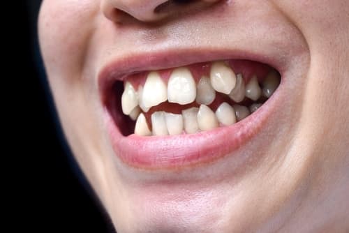 Close-up of an adult with prominent fang-like canine teeth causing dental crowding and misalignment, highlighting cosmetic and hygiene challenges.