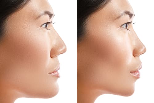 Side-by-side comparison of a woman’s facial profile before and after orthodontic or jaw correction, showing enhanced chin and facial harmony.