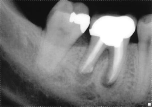 Post-root canal treatment dental X-ray showing crown restoration and root canal fillings; possible periapical radiolucency on lower molar suggesting reinfection