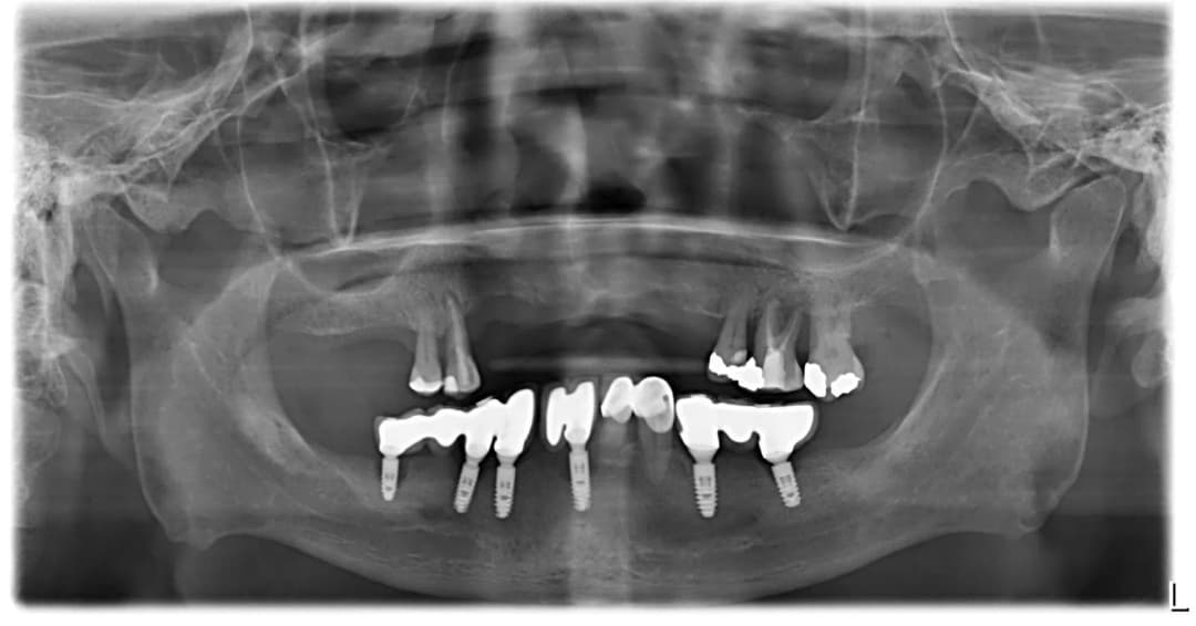 Pre-operative panoramic X-ray (OPG)