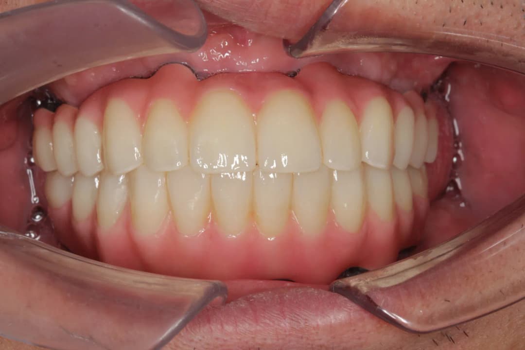 Post-treatment frontal view: implant-supported fixed bridge