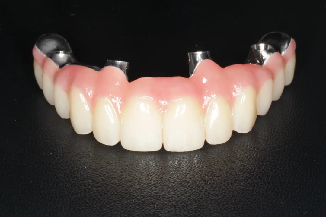 Final implant-supported fixed bridge (upper arch close-up)
