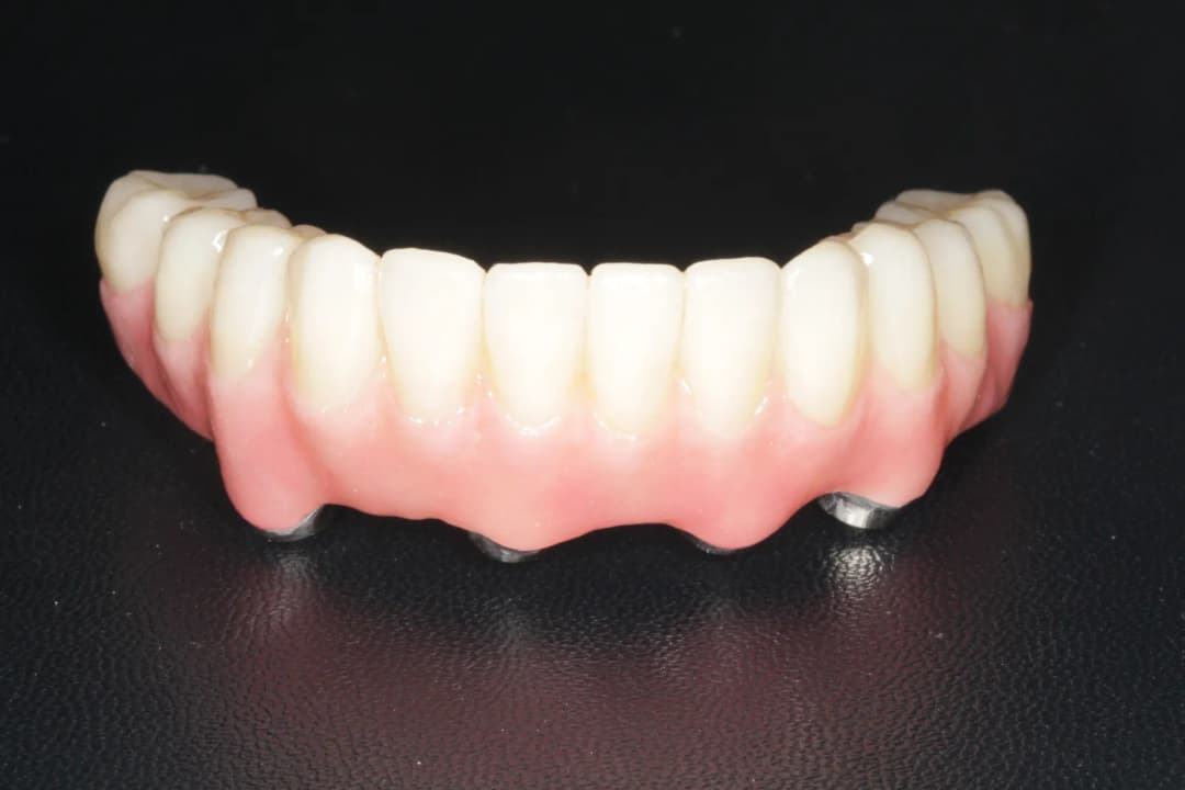 Final implant-supported fixed bridge (view from below)