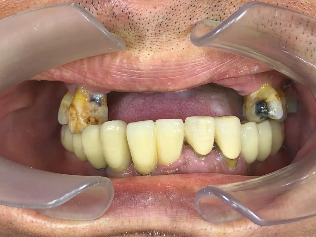 Pre-operative intraoral view: multiple severely decayed and mobile upper teeth