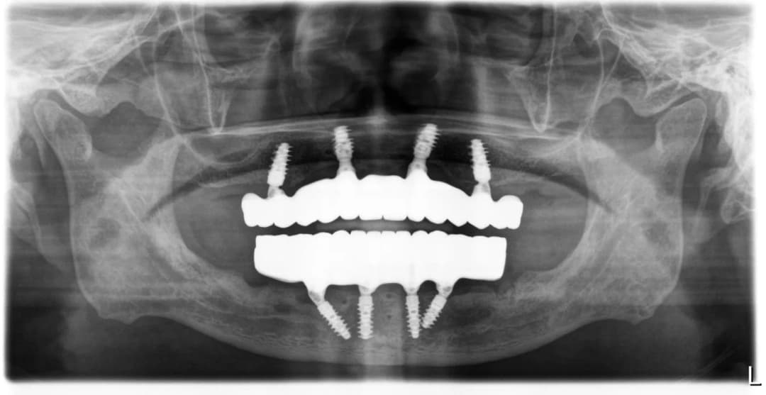 Post-operative panoramic X-ray: eight implants and fixed bridges across both arches