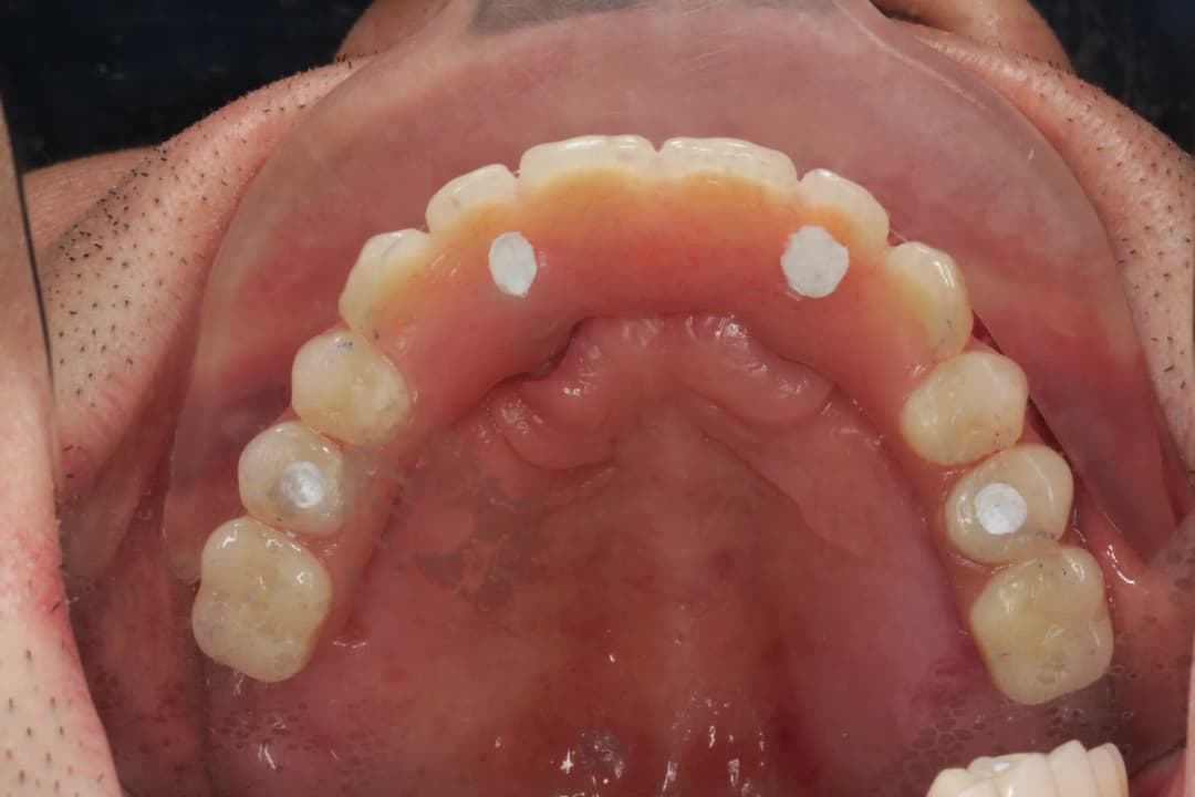 Provisional bridge worn while soft and hard tissues heal