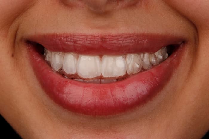Invisalign Hong Kong