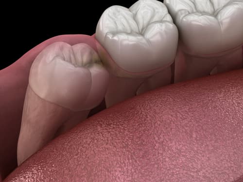 Hidden Wisdom Teeth: What "Impacted" Means and When Removal Is Discussed