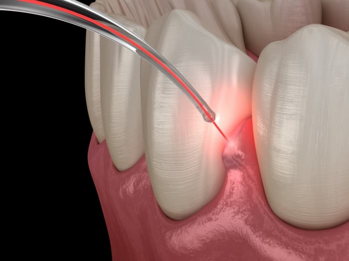 Hong Kong Dental Laser Treatment: Key Facts for Patients