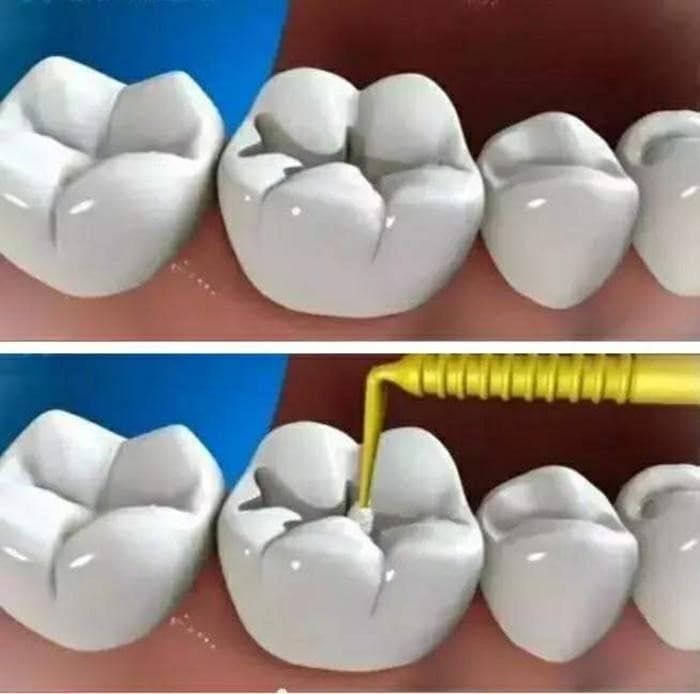 How to Choose Between a Filling, Inlay, Onlay, or Crown