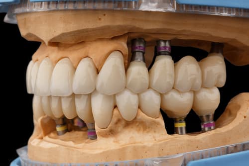 種牙植牙價錢