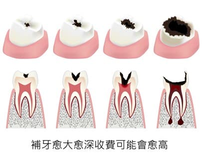 影响香港补牙收费的四大因素