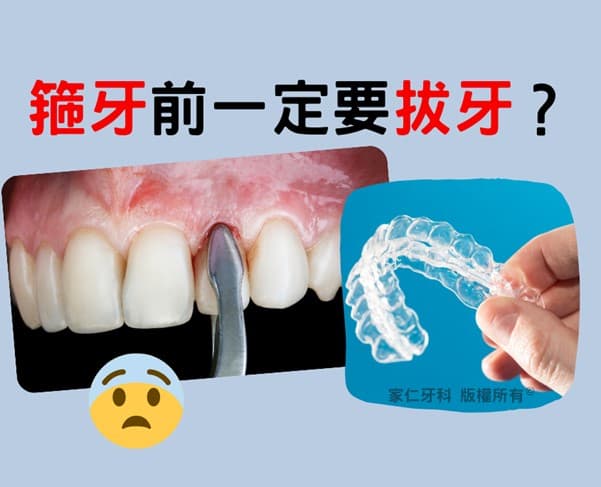 在香港做牙齿矫正(箍牙)前一定要拔牙吗?