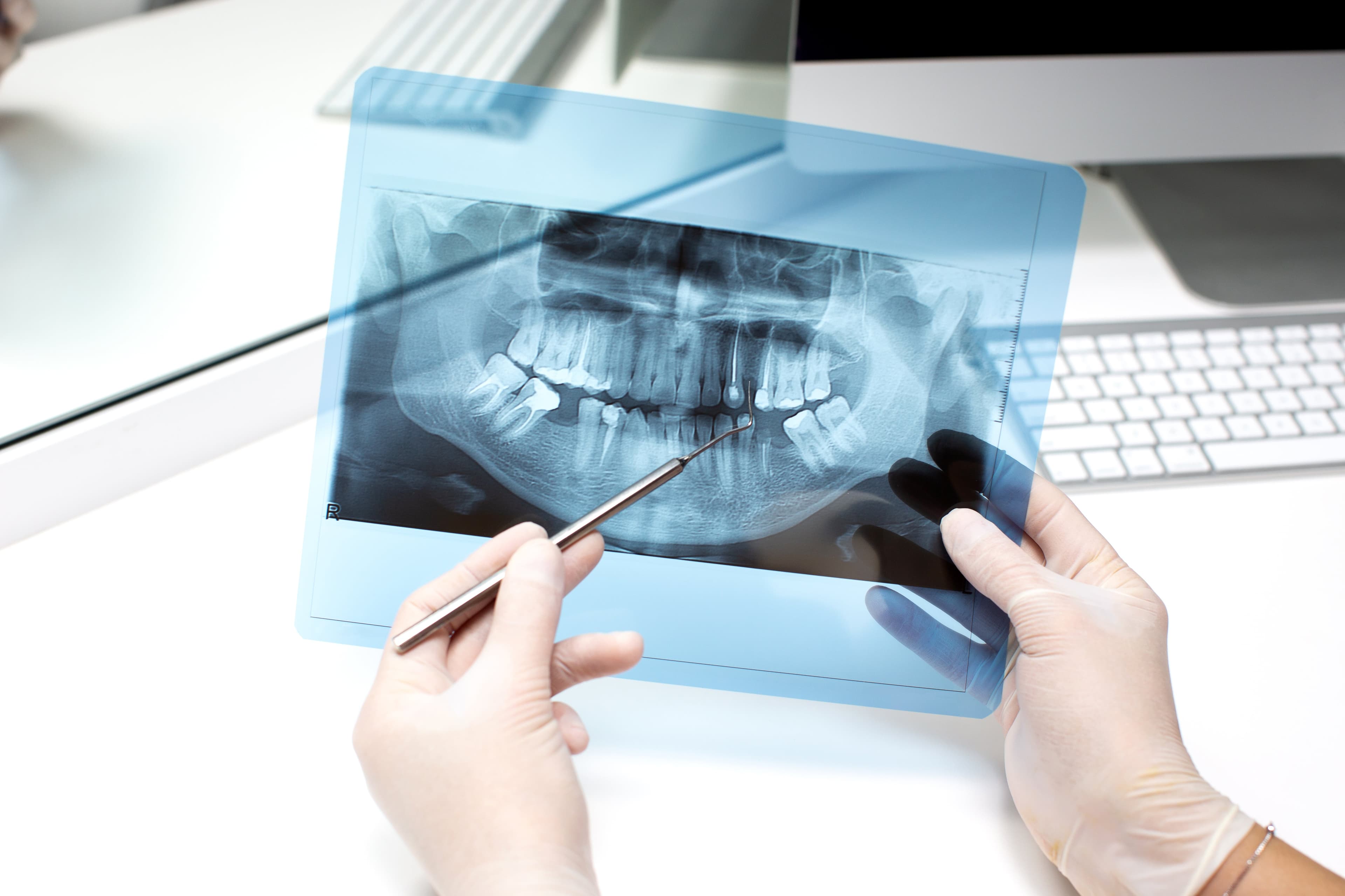 Should Wisdom Teeth in the Early Stages be Treated? Unveiling the Causes, Symptoms, and Solutions for Erupting Wisdom Teeth