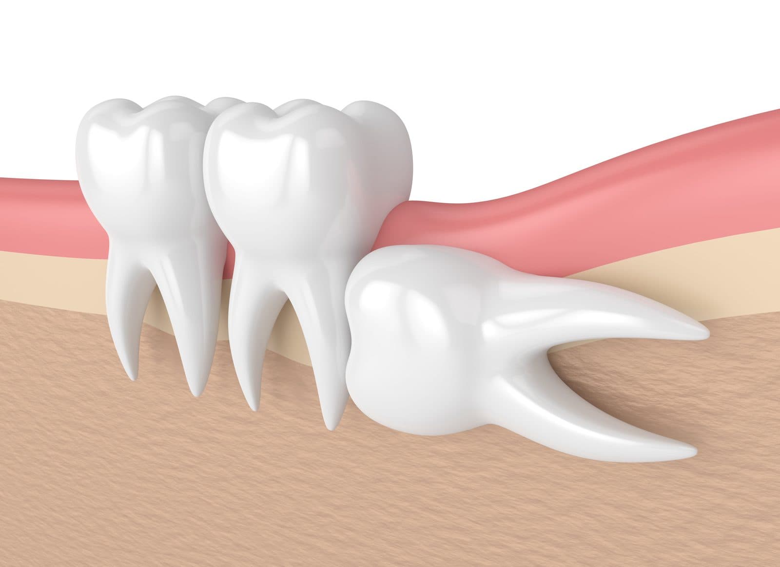 Is Wisdom Tooth Surgery Necessary? Guide to the Surgical Process and Risks