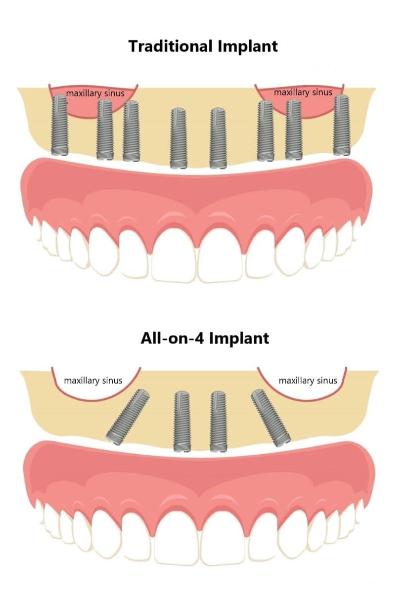 Comparing All-on-4 and Traditional Dental Implants: Unveiling the Distinctive Features