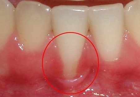 Concerned about gum bleeding? Understand the warning signs of gum bleeding!
