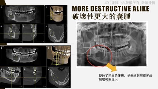 破壞性更大的囊腫X光對比圖。左側顯示牙齒延遲根管治療導致的囊腫發展;右側放大顯示囊腫侵蝕了牙齒和周圍組織,破壞範圍更大。