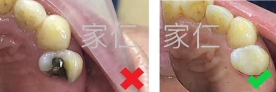 補牙修復前後對比圖。左側顯示修復前的情況,舊的補牙材料劣質且導致牙齒損壞;右側顯示修復後的情況,新的補牙材料安裝良好,恢復牙齒健康和功能。