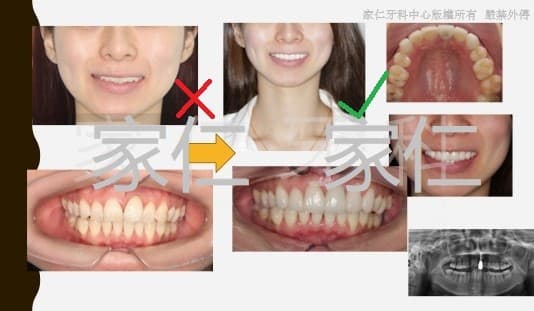 牙科美學改造案例,結合了瓷牙貼面、牙冠和植牙。左側顯示治療前的情況,牙齒排列不整齊,笑容欠佳;右側顯示治療後的情況,通過瓷牙貼面、牙冠和植牙修復,牙齒排列整齊,美觀自然,笑容自信。