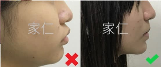 矯正失敗案例導致前牙外傾和前突加劇,修復前後對比圖。左側顯示治療前的情況,前牙明顯外傾,前突問題加劇;右側顯示修復後的情況,前牙位置正常,前突問題得到改善。
