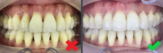 Comparison of black triangle treatment before and after: showing the treatment steps and final results of resin filling, veneers, and gum grafting, significantly improving the gingival embrasure issue