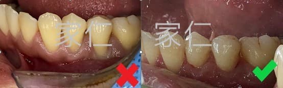 Comparison of gum grafting treatment before and after: the left side shows gum recession and black triangle issues before treatment, and the right side shows healthy gums and tightly aligned teeth after gum grafting, improving aesthetics and oral health.